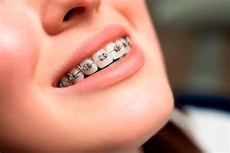 brackets metalicos precio argentina 2018|Cuánto sale un tratamiento de ortodoncia en argentina: precios, .